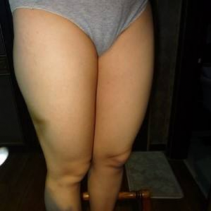 長沙真愛整形美容醫(yī)院醫(yī)生陳詠玲做大腿吸脂效果怎么樣？