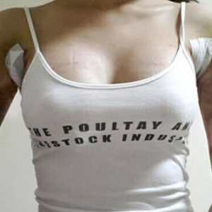 三亞圣迪亞整形美容醫(yī)院醫(yī)生韓超做假體隆胸怎么樣？附案例效果對(duì)比圖