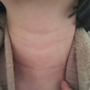 昭通愛(ài)麗諾整形醫(yī)生陳志江做嗨體去頸紋怎么樣？附案例效果圖