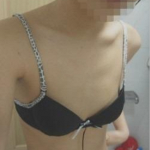 三亞圣迪亞整形美容醫(yī)院醫(yī)生韓超做假體隆胸怎么樣？附案例效果對(duì)比圖