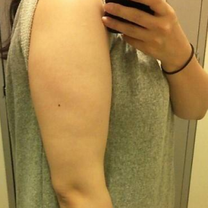 長沙柒和醫(yī)療整形醫(yī)生鐘滔做手臂吸脂怎么樣？附案例效果對比圖