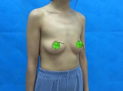 海南伊佳醫(yī)療美容醫(yī)院醫(yī)生涂陽(yáng)君做假體隆胸怎么樣？附案例效果對(duì)比圖