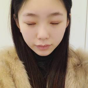 鄭州安格潤整形醫(yī)生楊曉紅做雙眼皮手術(shù)怎么樣？附案例效果圖