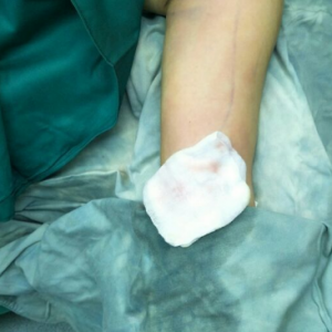 長沙柒和醫(yī)療整形醫(yī)生鐘滔做手臂吸脂怎么樣？附案例效果對(duì)比圖