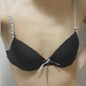 三亞圣迪亞整形美容醫(yī)院醫(yī)生韓超做假體隆胸怎么樣？附案例效果對(duì)比圖