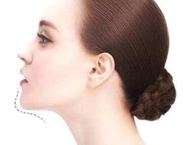 遵義利美康整形醫(yī)院假體隆下巴