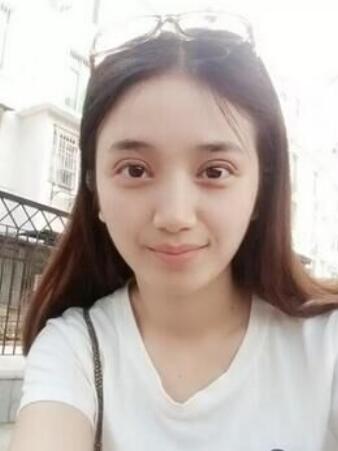 長治松禾醫(yī)療美容診所醫(yī)生馬俊峰做韓式微創(chuàng)定點雙眼皮效果怎么樣？附案例