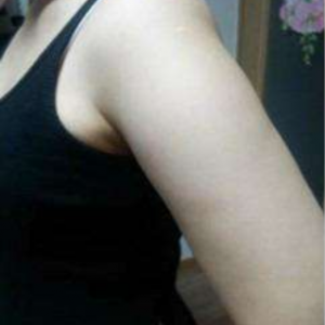 長沙柒和醫(yī)療整形醫(yī)生鐘滔做手臂吸脂怎么樣？附案例效果對(duì)比圖