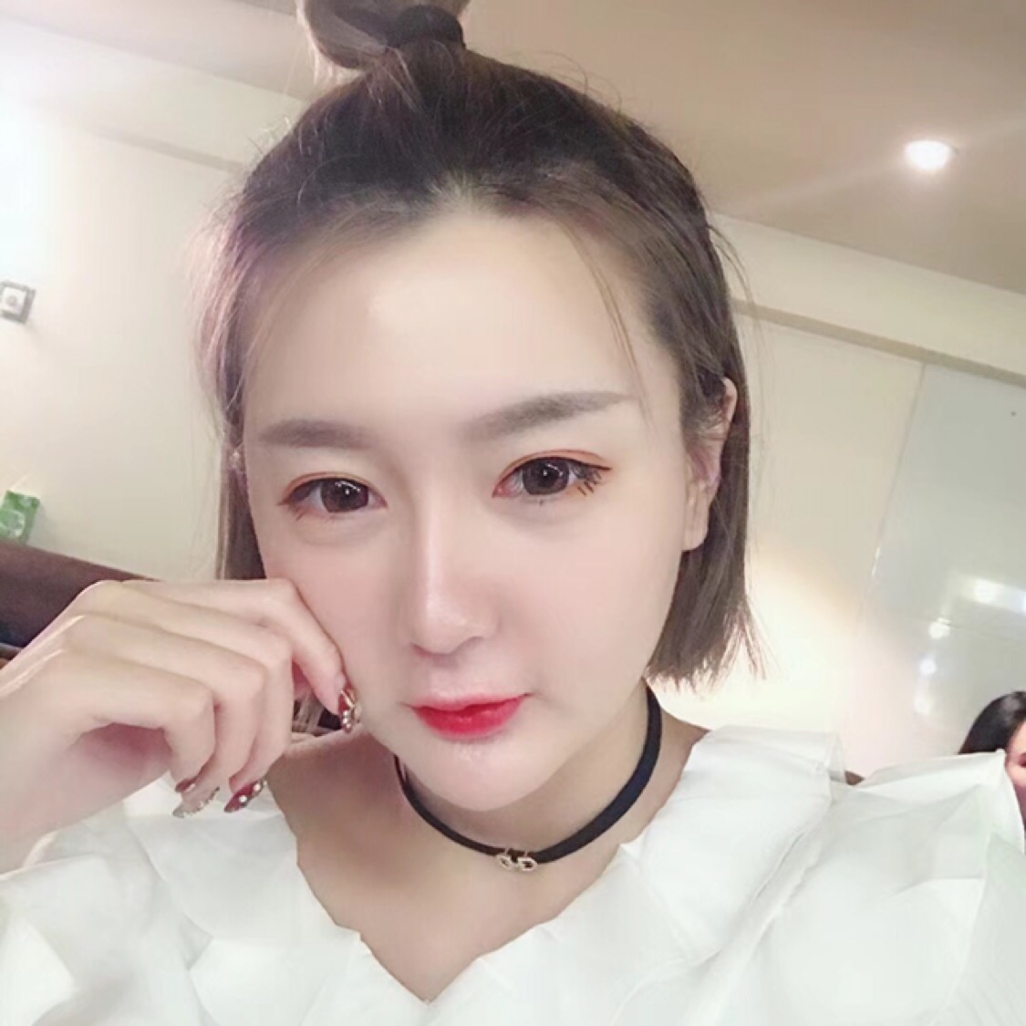 杭州格萊美整形美容醫(yī)院醫(yī)生張霞飛做自體脂肪全臉填充效果怎么樣？