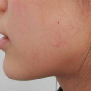 蚌埠韓美美萊整形醫(yī)院醫(yī)生張濤做玻尿酸墊下巴怎么樣？來看案例效果圖