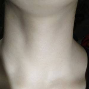 昭通愛(ài)麗諾整形醫(yī)生陳志江做嗨體去頸紋怎么樣？附案例效果圖