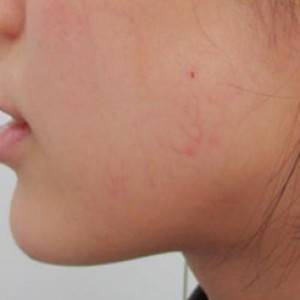 蚌埠韓美美萊整形醫(yī)院醫(yī)生張濤做玻尿酸墊下巴怎么樣？來看案例效果圖