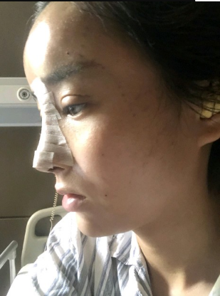 武漢米蘭醫(yī)療美容醫(yī)生柳再億做眼綜合+鼻綜合整形怎么樣？附真實案例對比圖