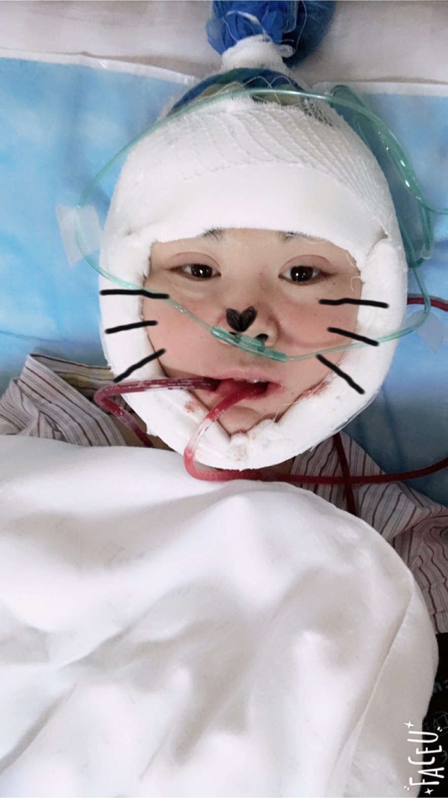 北京彤美美容整形醫(yī)院醫(yī)生楊曉惠做顴骨內(nèi)推+面部吸脂手術效果怎么樣？附案例