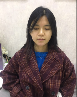 上海時光整形外科醫(yī)院醫(yī)生何晉龍做假體隆胸怎么樣？附案例效果對比圖