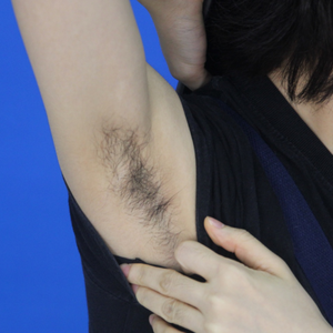 重慶中成整形美容醫(yī)院醫(yī)生田忠成激光脫腋毛效果怎么樣？附案例效果圖