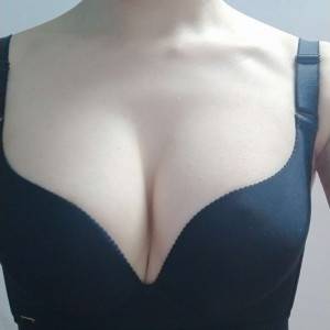 長沙亞韓醫(yī)學美容醫(yī)院醫(yī)生鄭京湘做假體隆胸怎么樣？附醫(yī)生案例效果對比圖