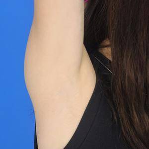 重慶中成整形美容醫(yī)院醫(yī)生田忠成激光脫腋毛效果怎么樣？附案例效果圖