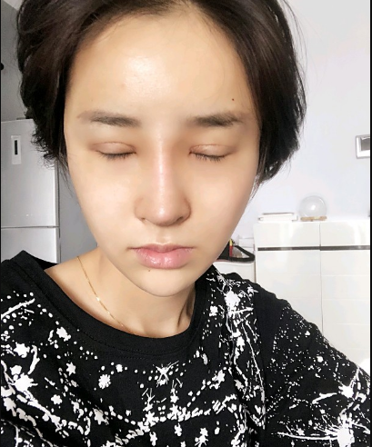 武漢米蘭醫(yī)療美容醫(yī)生柳再億做眼綜合+鼻綜合整形怎么樣？附真實案例對比圖