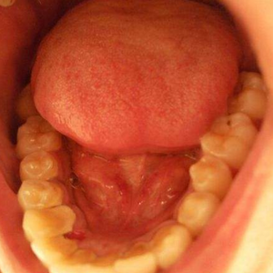 淄博口腔醫(yī)院醫(yī)生牟象鑫做超聲波洗牙怎么樣？附案例效果對比圖