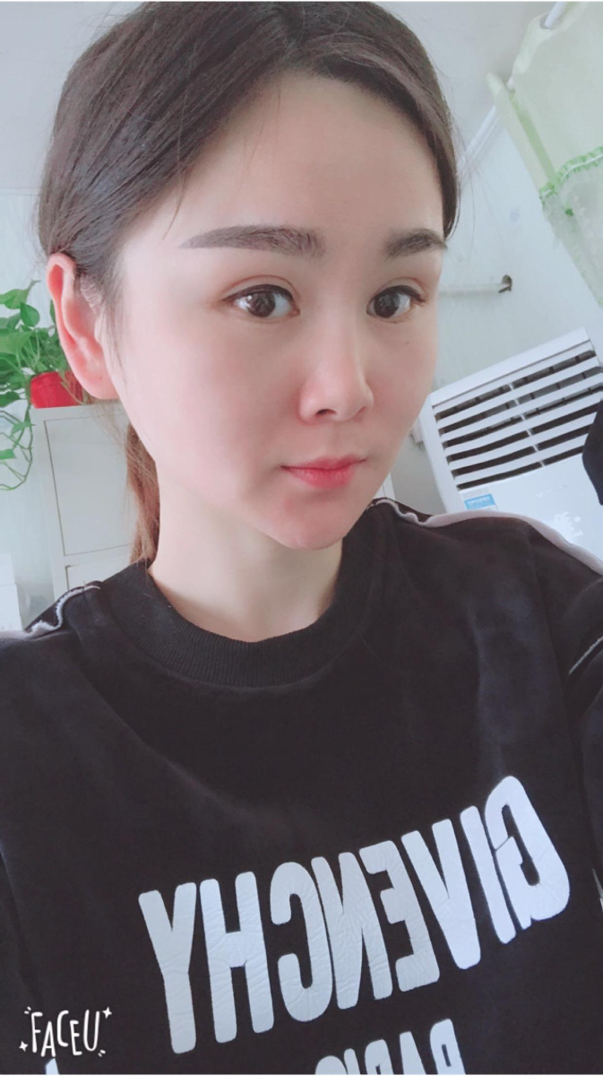 北京彤美美容整形醫(yī)院醫(yī)生楊曉惠做顴骨內(nèi)推+面部吸脂手術(shù)效果怎么樣？附案例