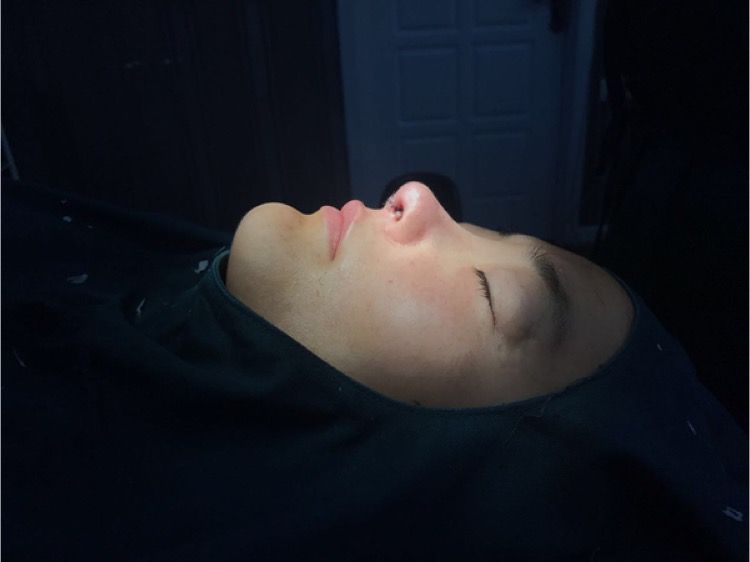 北京集美名媛醫(yī)療整形醫(yī)生陳瀅雯做自體耳軟骨隆鼻怎么樣？附案例效果圖