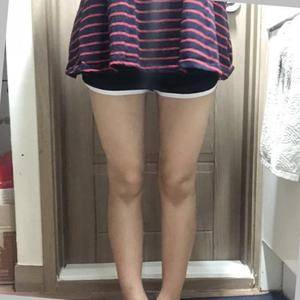 貴陽(yáng)華美整形美容醫(yī)院醫(yī)生田永華做大腿吸脂效果怎么樣？附大腿吸脂案例前后對(duì)比圖