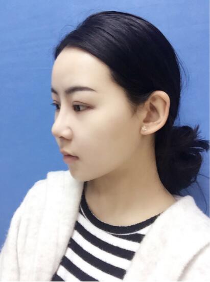 上海時光整形外科醫(yī)院醫(yī)生李靜林做假體隆鼻和反頜手術(shù)怎么樣？