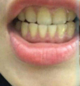 淄博口腔醫(yī)院醫(yī)生牟象鑫做超聲波洗牙怎么樣？附案例效果對(duì)比圖