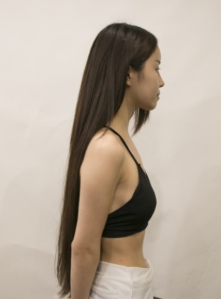 吉林現(xiàn)代整形美容醫(yī)院做假體隆胸效果怎么樣？附醫(yī)院案例效果對比圖