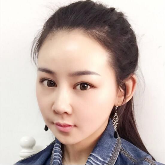 上海時光整形外科醫(yī)院醫(yī)生李靜林做假體隆鼻和反頜手術(shù)怎么樣？