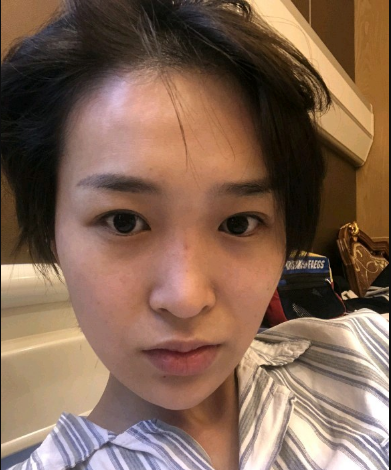 武漢米蘭醫(yī)療美容醫(yī)生柳再億做眼綜合+鼻綜合整形怎么樣？附真實案例對比圖