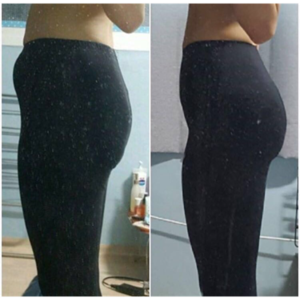 貴陽(yáng)華美整形美容醫(yī)院醫(yī)生田永華做大腿吸脂效果怎么樣？附大腿吸脂案例前后對(duì)比圖