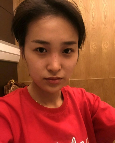 武漢米蘭醫(yī)療美容醫(yī)生柳再億做眼綜合+鼻綜合整形怎么樣？附真實案例對比圖