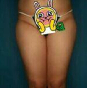 貴陽(yáng)華美整形美容醫(yī)院醫(yī)生田永華做大腿吸脂效果怎么樣？附大腿吸脂案例前后對(duì)比圖