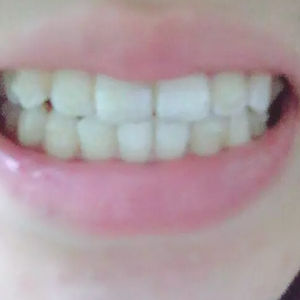 淄博口腔醫(yī)院醫(yī)生牟象鑫做超聲波洗牙怎么樣？附案例效果對比圖