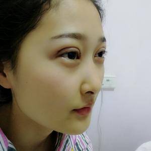 周口垣夢醫(yī)療整形醫(yī)生王濤做切開雙眼皮怎么樣？附切開雙眼皮案例效果對比圖