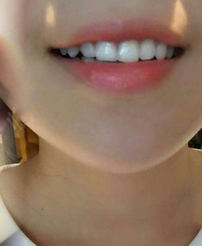 淄博口腔醫(yī)院醫(yī)生牟象鑫做超聲波洗牙怎么樣？附案例效果對比圖