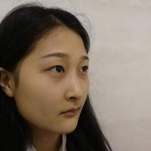 周口垣夢醫(yī)療整形醫(yī)生王濤做切開雙眼皮怎么樣？附切開雙眼皮案例效果對比圖