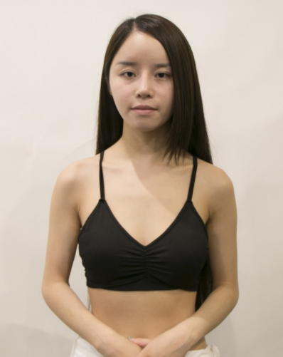 吉林現(xiàn)代整形美容醫(yī)院做假體隆胸效果怎么樣？附醫(yī)院案例效果對(duì)比圖