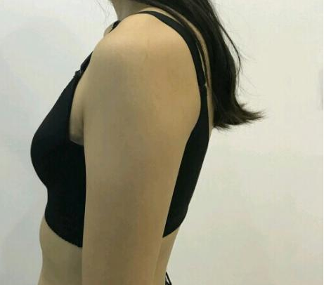 武漢伽美醫(yī)療美容醫(yī)院醫(yī)生朱富初做自體脂肪隆胸怎么樣？看案例