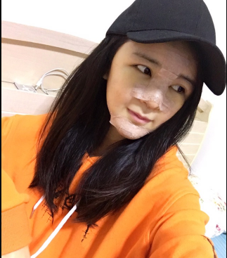 上海時光整形外科醫(yī)院醫(yī)生何晉龍做假體隆胸怎么樣？附案例效果對比圖