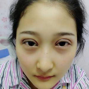 周口垣夢醫(yī)療整形醫(yī)生王濤做切開雙眼皮怎么樣？附切開雙眼皮案例效果對比圖