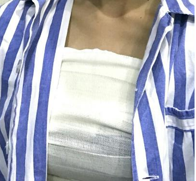 武漢伽美醫(yī)療美容醫(yī)院醫(yī)生朱富初做自體脂肪隆胸怎么樣？看案例