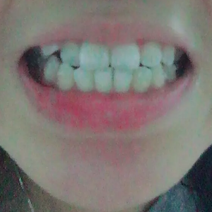 淄博口腔醫(yī)院醫(yī)生牟象鑫做超聲波洗牙怎么樣？附案例效果對比圖