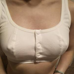 長沙亞韓醫(yī)學美容醫(yī)院醫(yī)生鄭京湘做假體隆胸怎么樣？附醫(yī)生案例效果對比圖