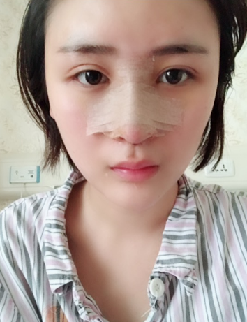 北京伊美爾美容愛康醫(yī)院醫(yī)生柳成做鼻綜合整形怎么樣？附案例效果圖