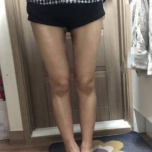 貴陽(yáng)華美整形美容醫(yī)院醫(yī)生田永華做大腿吸脂效果怎么樣？附大腿吸脂案例前后對(duì)比圖