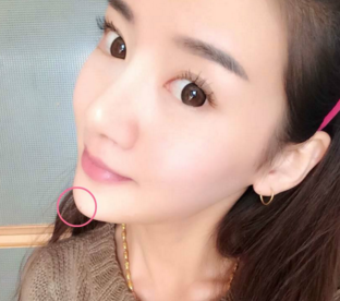 阜陽(yáng)市人民醫(yī)院吸脂瘦臉