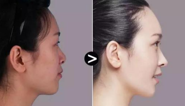 蘭州明倫醫(yī)療美容門(mén)診部假體豐額頭